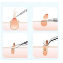 Kit Profissional Extrator de Espinhas – 4 Peças/Conjunto, Dupla Ponta com Pinça, Extrator e Agulha, para Salão